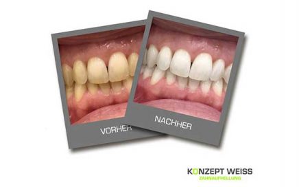 KONZEPT WEISS – Zahnaufhellung vor der Hochzeit in Dresden